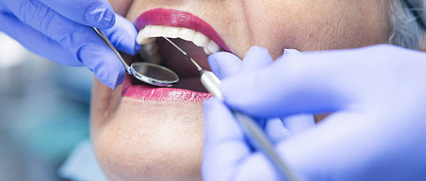 Best Knocked-Out Tooth (Avulsed Tooth) Treatment in Parrish, AL